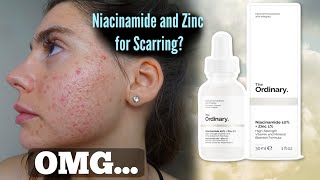 I TESTED THE ORDINARY NIACINAMIDE AND ZINC SERUM FOR MY ACNE SCARS ONE MONTH Shocked by this [upl. by Berner]