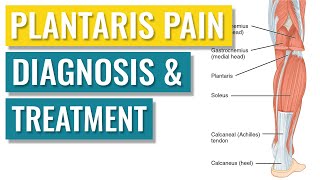 Plantaris Tendonitis  Symptoms and Treatment [upl. by Colb]