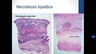 Basic Dermatopathology 11 Granulomatous [upl. by Emmeline]