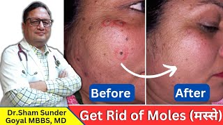 Mole मस्से Removal Procedure  Get Rid of Moles [upl. by Elamor995]