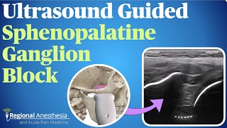 Ultrasound Guided Sphenopalatine Ganglion Block [upl. by Aelanej868]