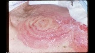 ERYTHEMA IN MEDICINE 1 [upl. by Kellene]