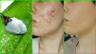 COMO ELIMINAR EL ACNE NATURALMENTE CON SABILA [upl. by Yasu688]