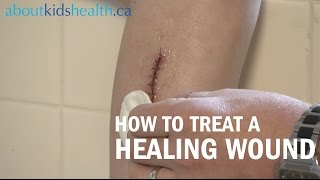 How to care for a healing wound  AboutKidsHealth at The Hospital for Sick Children [upl. by Floyd]