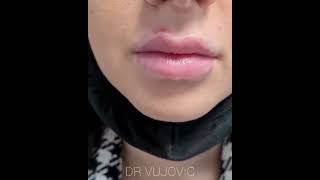 Lips Augmentation 1cc hyaluronic filler💉 video [upl. by Waller]