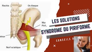 Syndrome du piriforme  Stop aux douleurs de sciatique [upl. by Iilek]