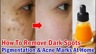 How To Get Rid Of Dark Spots Pigmentation amp Acne Scars Easily At Home  100 Results [upl. by Llyrad]