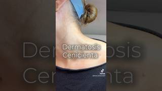 Dermatosis Cenicienta dermatology dermatosis dermatitis manchas rascarse [upl. by Dafna32]