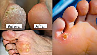 how to remove corns foot corn treatment  foot corn removal  corns and calluses  corn cap [upl. by Vinny]