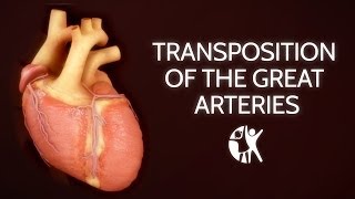 Transposition of the Great Arteries [upl. by Ellivro]