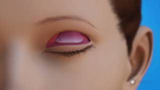 Levator Resection for Ptosis Repair Surgery Eyelid Lift [upl. by Adnarrim]