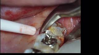 difficult tooth extraction upper right molar 右上7番難抜歯 [upl. by Whitelaw697]