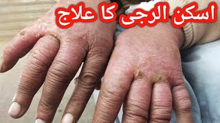 psoriasis treatmentskin allergypsoriasis signpsoriasis [upl. by Nievelt]