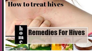 How to treat hives  home remedy for hives [upl. by Kcirdek]