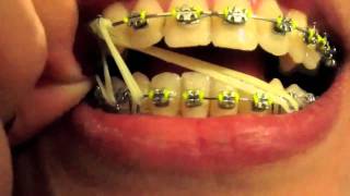 Braces Update  13 Eight Elastics [upl. by Zebulen]