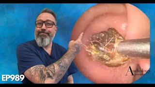 The MOST SATISFYING ring of dry ear wax removal EP989 [upl. by Mella]