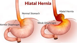 HIATAL HERNIA CAUSES SYMPTOMS AND MANAGEMENT BSCGNM NURSING dailypost [upl. by Havstad]