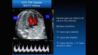 Basic Fetal Echocardiography [upl. by Ynnaj]