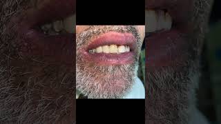 Flexible denture after extraction with fixed denture [upl. by Kyle]