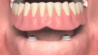 Locator™  installation guide  Dentsply Sirona [upl. by Gayelord]