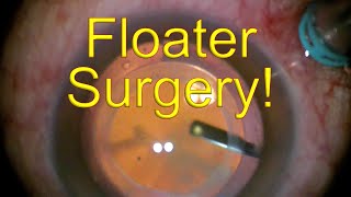 Surgery for EYE FLOATERS MASSIVE  Vitrectomy for eye floaters  Dr Simon Chen [upl. by Ecnarret]