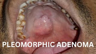 Histopathology of Pleomorphic Adenoma amp other Salivary Tumours [upl. by Nnyliak]