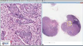 Breast Invasive carcinoma NST with lymph node metastases Microscopy Talking slide [upl. by Cavuoto738]