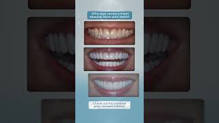 No Need To Shave Teeth For Veneers MinimalPrepVeneers [upl. by Schott328]