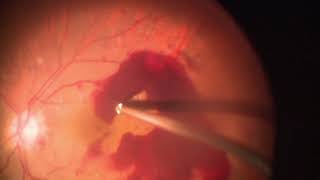 Vitrectomy for Subhyaloid blood over macula in Diabetic retinopathy  PDR  Dr Manish Nagpal [upl. by Reich]