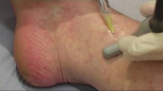 Microsclerotherapy video 2 [upl. by Kreegar]