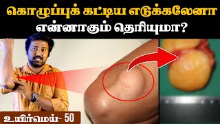 கொழுப்புக் கட்டி ஆபத்தானதா  Lipoma removal tamil  fat ball bumps tamil  Uyirmei Ep50 [upl. by Yatnahs954]