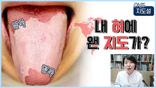 혀 백태가 벗겨지면서 따가운 증상 지도설 원인과 치료법은 [upl. by Izaak866]