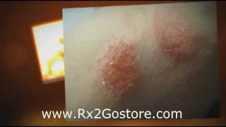 Clobetasol Cream  How to Treat Psoriasis and Eczema [upl. by Hughett548]