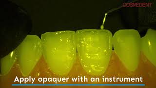 Enhancing the Halo Effect on Composite Restorations with Creative Color Opaquers [upl. by Ranita]