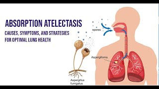 Absorption Atelectasis Unveiled  Causes Effects and More [upl. by Enrol435]