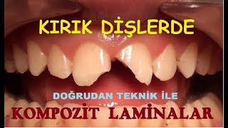 Kırık Ön Dişlerde Kompozit Laminalar 2 [upl. by Yllime]