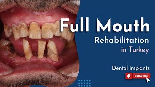 Full Mouth Rehabilitation  Dental Implants in Istanbul TURKEY [upl. by Higinbotham377]