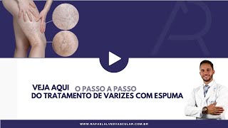 Tratamento de Varizes com Espuma  Veja aqui o passo a passo [upl. by Orsay]