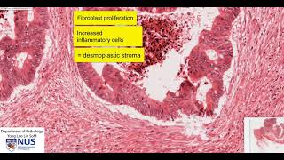 Colon carcinoma microscopy  Talking slide [upl. by Navlys600]