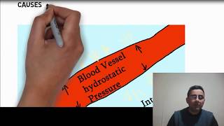 Edema  Swelling causes and types  explained simply [upl. by Idoj172]