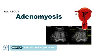 ADENOMYOSIS TYPES SYMPTOMS  DIAGNOSIS TREATMENT  NEETPG  INICET  MEDICOS [upl. by Naed120]