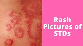 What’s This Rash Pictures of STDs [upl. by Alguire]