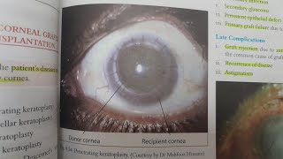 Keratoplasty  EYE [upl. by Naujit599]