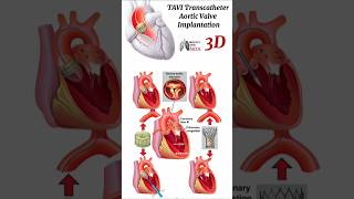 TAVI Transcatheter Aortic Valve Implantation medical animation 3d short [upl. by Atteynod637]