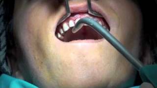 periodontal flap operasyonu [upl. by Alleynad]