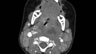 Retropharyngeal Abscess Imaging Studies short version [upl. by Aoh]