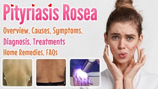 Pityriasis Rosea Overview Causes Signs and Symptoms Diagnosis Treatment Home Remedies and FAQs [upl. by Hairom23]