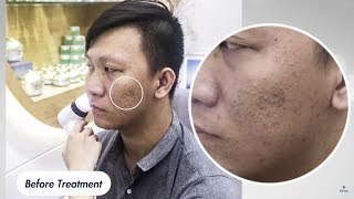 Before amp After Blackhead Removal 55min by Gà Spa  Feeling so satisfied [upl. by Sulihpoeht577]