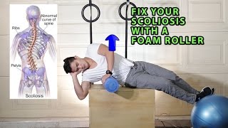 Fix Your Scoliosis with a Foam Roller Scroths Method [upl. by Aneeg606]