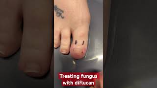 Successful fungal nail treatment centralmasspodiatry drpelto [upl. by Pinebrook]